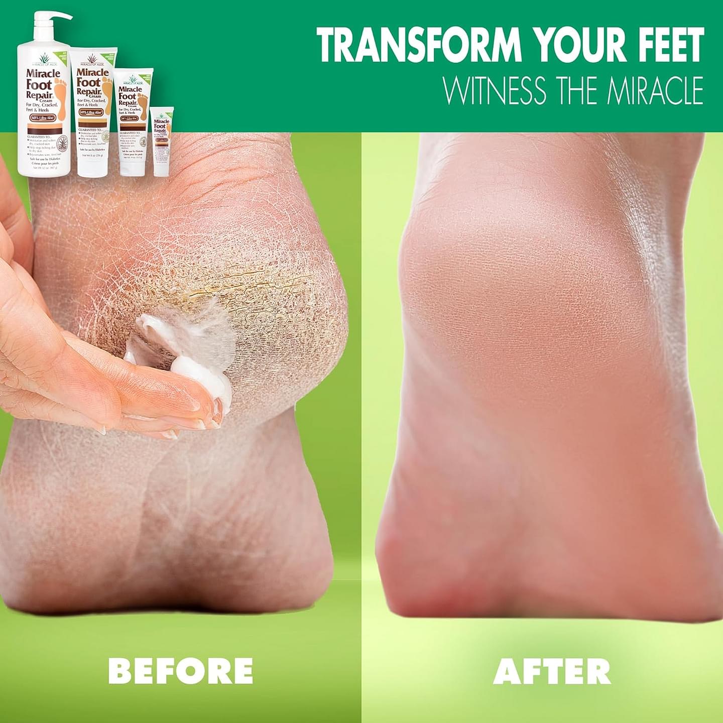 Miracle Foot Repair Cream (32 oz) Repairs Dry Cracked Heels and Feet, 60% Pure UltraAloe Moisturizes, Softens, and Repairs 32 Ounce (Pack of 1)