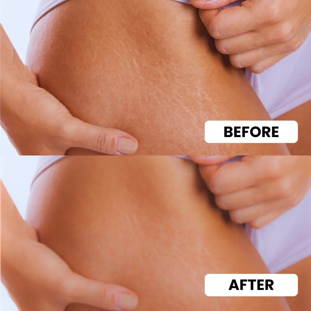 Stretch Mark Eraser - Ayurvedic Stretch Mark Cream with Gotu Kola, Tamanu Oil, Rosehip & Shea Butter for Hydrated, Smooth and Elastic Skin