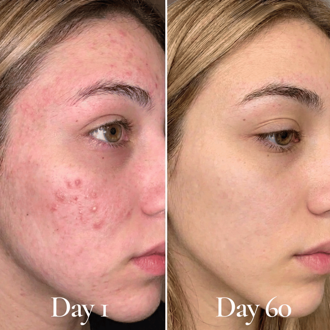 The Deep Barrier Repair Routine - Probiotic and Ceramide Skincare System